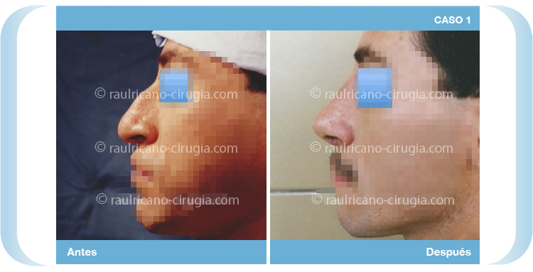 E - Operacion nariz - caso 1, mejor cirujano plástico Puebla