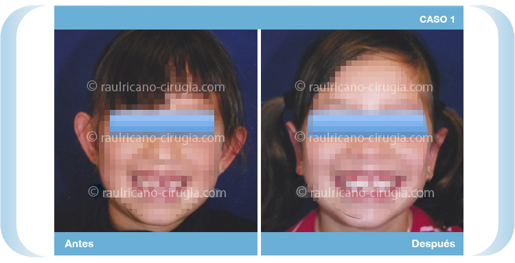 E - Operacion orejas - caso 1, mejor cirujano plástico Puebla