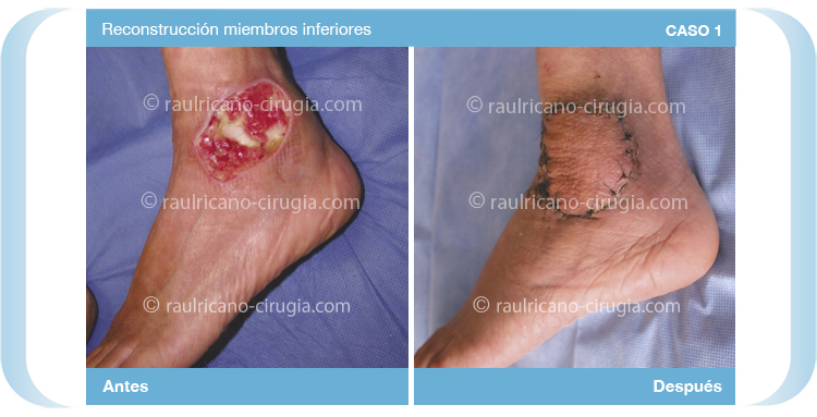 Reconstruccion - Miembros Inferiores, pies piernas  - caso 1, mejor cirujano plástico Puebla
