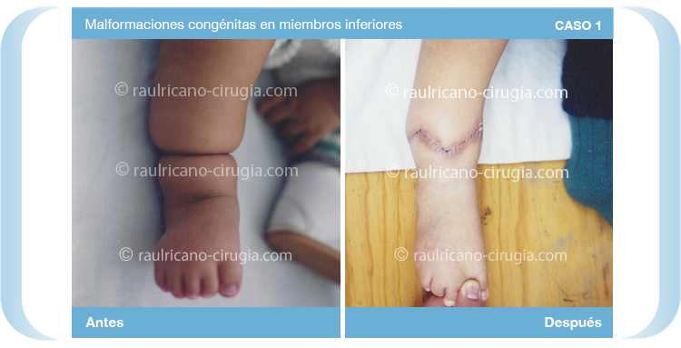 Reconstruccion  - Miembros Inferiores, pies  piernas,  - caso 1a, mejor cirujano plástico Puebla