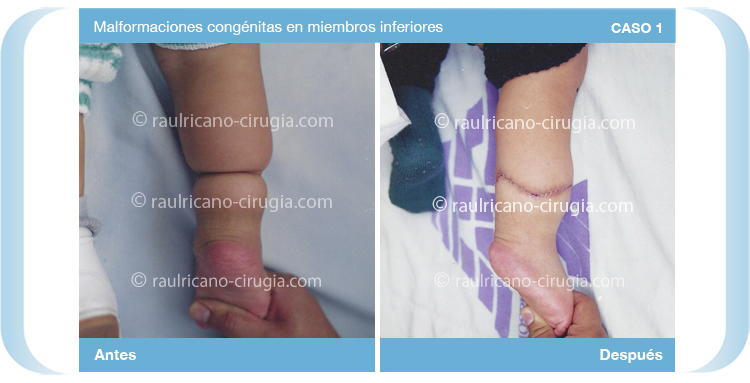 Reconstruccion  - Miembros Inferiores , pies piernas - caso 1b, mejor cirujano plástico Puebla