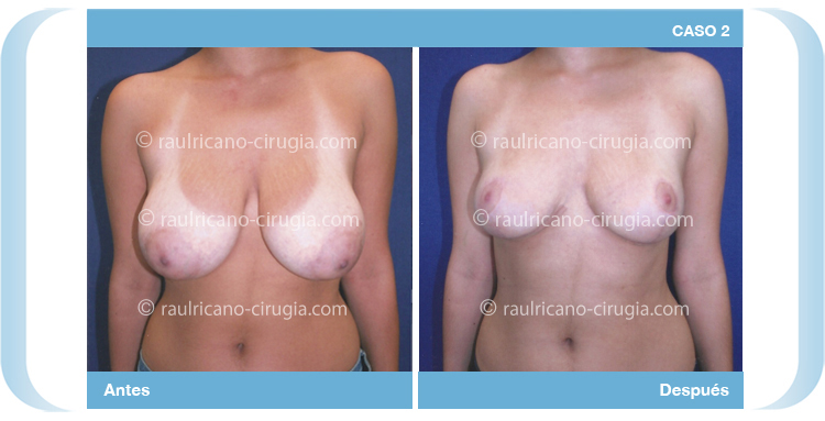 E- Senos Reducción  mamaria pechos - caso 2, mejor cirujano plastico puebla