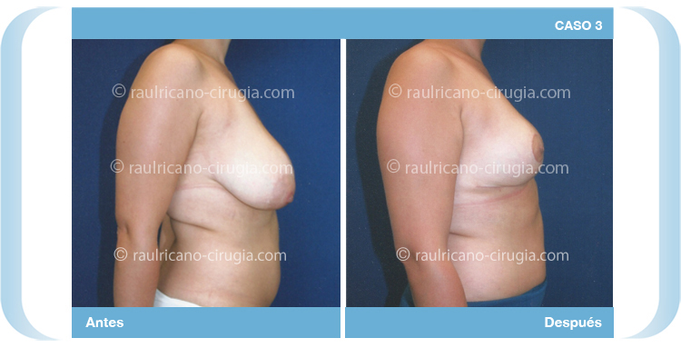 E- Senos Reducción  mamaria pechos - caso 3, mejor cirujano plastico puebla