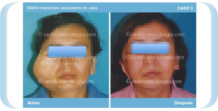 Reconstruccion  - Cara - caso 3, mejor cirujano plástico Puebla
