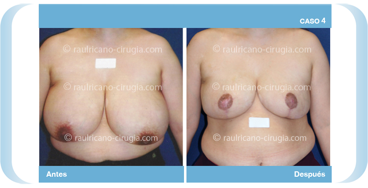 E- Senos Reducción mamaria pechos - caso 4, mejor cirujano plastico puebla