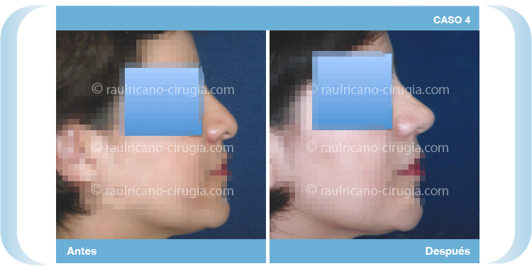 E – Operacion nariz – caso 4, mejor cirujano plástico Puebla