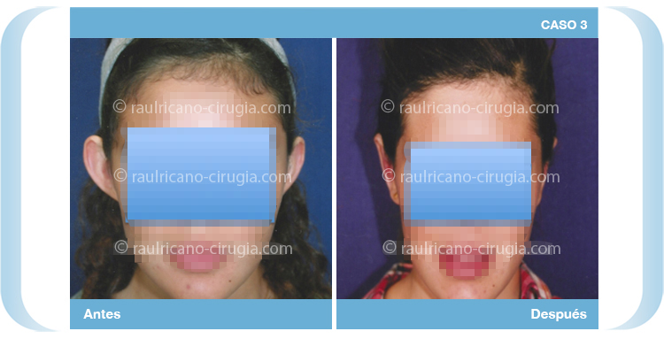 E – Operacion orejas – caso 3, mejor cirujano plástico Puebla