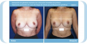 R reconstrucción de mamas post-mastectomía 1 (frente) Caso 4