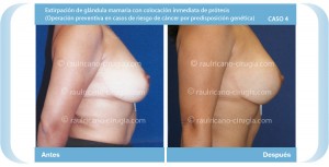 R reconstrucción de mamas post-mastectomía 2 (perfil dcho) Caso 4