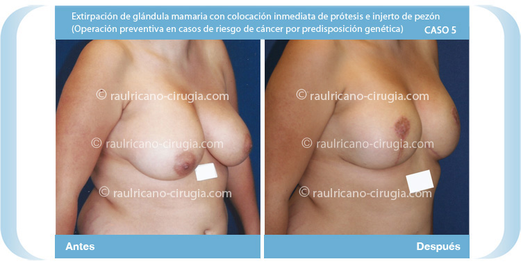 R reconstrucción de mamas post-mastectomía 2 (tres cuartos dcha) Caso 5