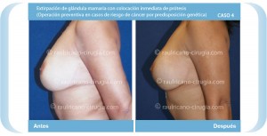 R reconstrucción de mamas post-mastectomía 3 (perfil izq) Caso 4
