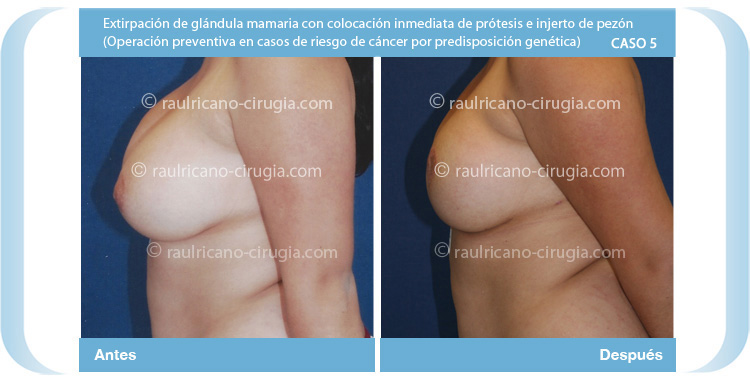 R reconstrucción de mamas post-mastectomía 3 (perfil izq) Caso 5