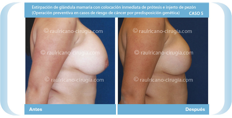 R reconstrucción de mamas post-mastectomía 4 (perfil dcho) Caso 5