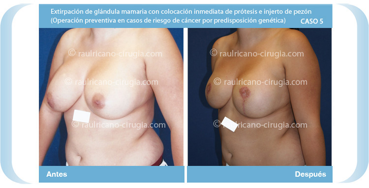R reconstrucción de mamas post-mastectomía 5 (tres cuartos izq) Caso 5