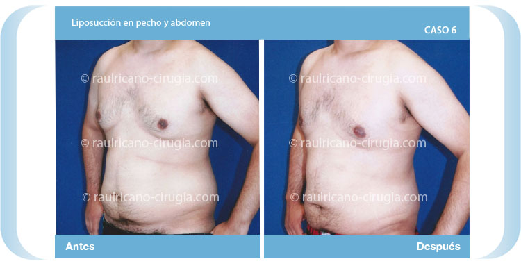 E- liposucción de pecho y abdomen- Caso 6, Mejores cirujanos plásticos en México