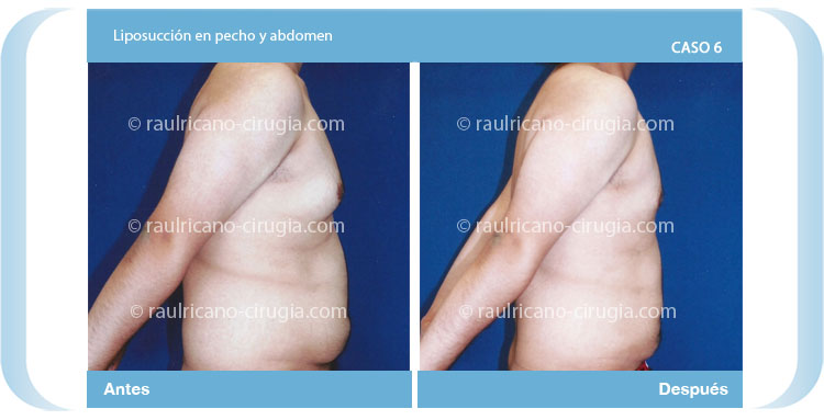 E- liposucción de pecho y abdomen- perfil Caso 6,  Cirujanos plásticos certificados en México