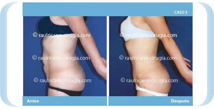 Liposucción espalda y abdomen