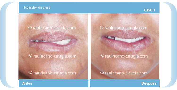 E- Inyección grasa labio Caso 1. Dr.Raúl Ricaño Rueda Cirujano Plástico Certificado