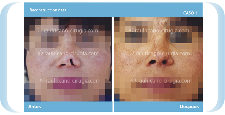 E- Reconstrucción nasal 1- Caso 1. Dr. Raúl Ricaño Rueda Cirujano Plástico Certificado
