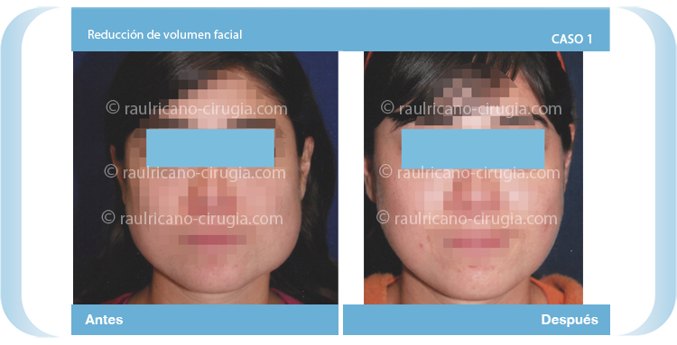 E- Reconstrucción nasal- Caso 1. Cirujanos plásticos certificados en México