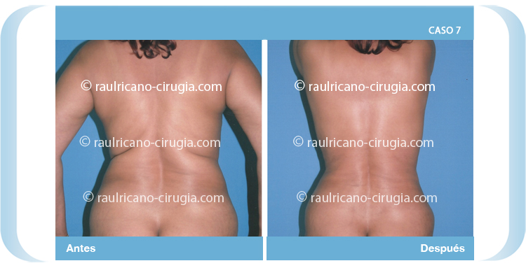 E- liposucción de espalda - Caso 7. Mejores cirujanos plásticos de México
