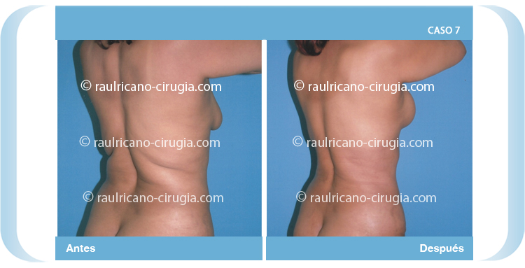 E- liposucción de espalda perfil - Caso 7. Dr. Raúl Ricaño Rueda, Cirujano Plástico