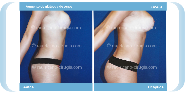 Aumento de glúteos y senos- Caso 4. Cirujanos certificados en México