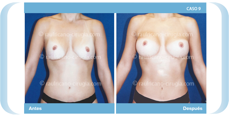 Aumento de senos prótesis redondas C-9. Cirujanos plásticos certificados de México