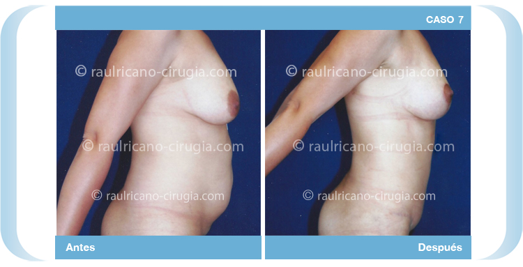 Abominoplastia liposucción levantamiento mamario