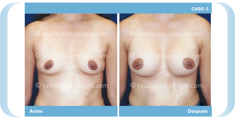E - senos aumento prótesis anatómicas en forma de gota. Cirujanos plásticos certificados en México