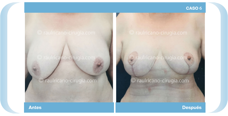 C6 Levantamiento mamario El doctor Raúl Ricaño Rueda es uno de los mejores cirujanos plásticos de México
