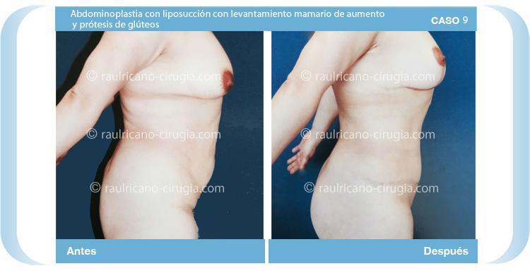 C9 Abdominoplastia con liposucción y levantamiento mamario de aumento y prótesis de glúteos Mejores cirujanos plásticos de Puebla Raúl Ricaño Rueda