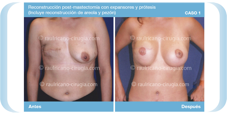 Reconstruccion - Senos, mamas  - caso 1, mamas, mejor cirujano plástico Puebla