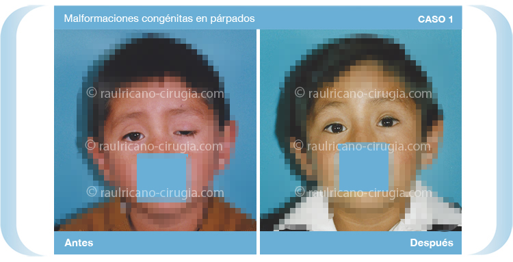 Reconstruccion  - Cara - caso 1, mejor cirujano plástico Puebla