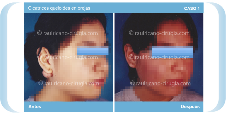 Reconstruccion - Cara - C1, mejor cirujano plástico Puebla