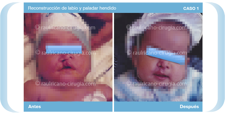 Reconstruccion  - Cara - C1, mejor cirujano plástico Puebla