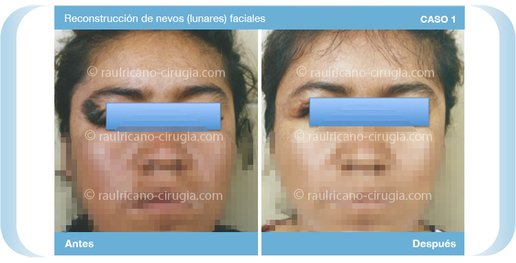 Reconstruccion  - Cara - C1, mejor cirujano plástico Puebla