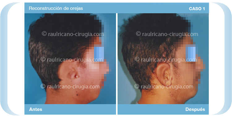Reconstruccion  - Cara - C1, mejor cirujano plástico Puebla