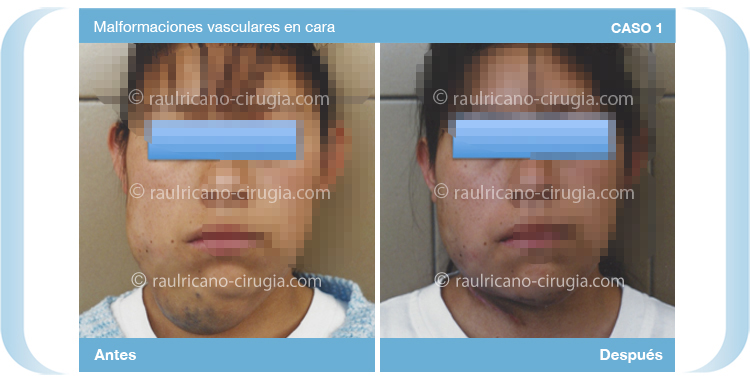 Reconstruccion - Cara - caso 1a, mejor cirujano plástico Puebla