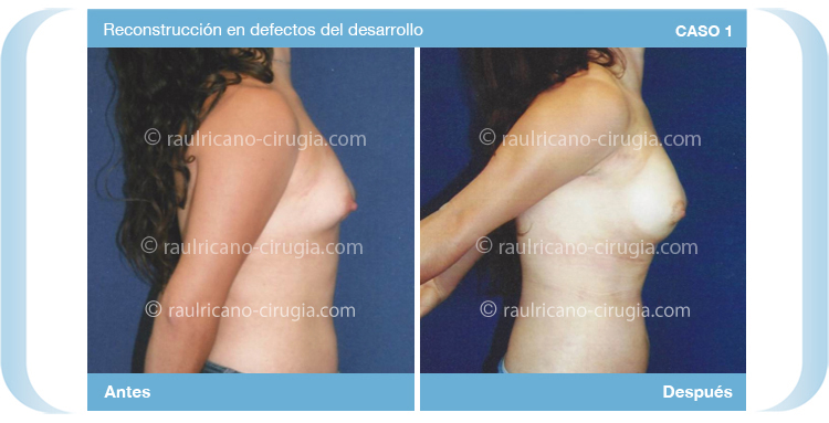 Reconstruccion  - Senos, mamas - caso 1b, mamas,  mejor cirujano plástico Puebla