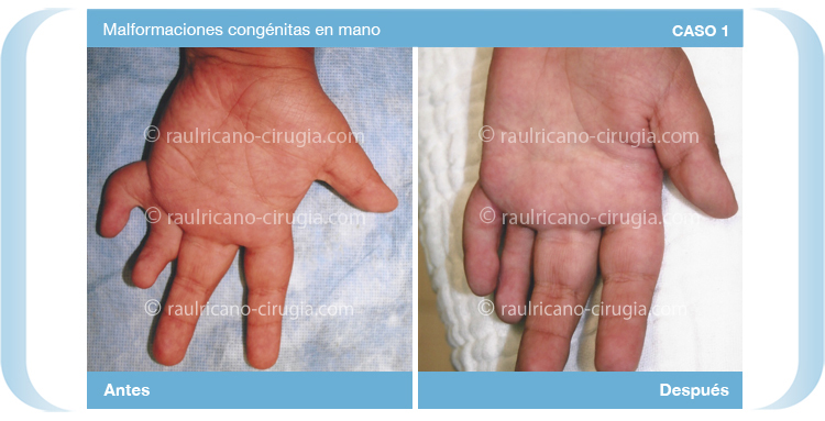 Reconstruccion - Miembros Superiores  manos - caso 1b, mejor cirujano plástico Puebla
