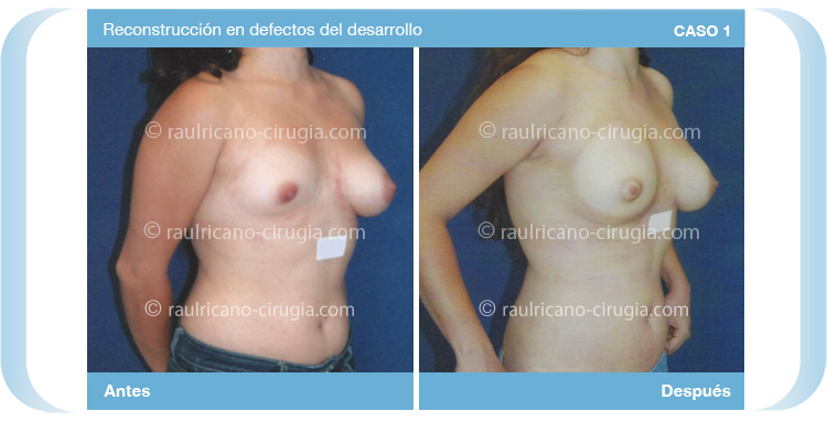 Reconstruccion  - Senos, mamas - caso 1c, mejor cirujano plástico Puebla