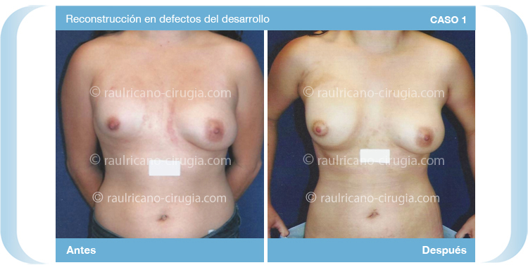 Reconstruccion - Senos, mamas - caso 1d, mamas,  mejor cirujano plástico Puebla