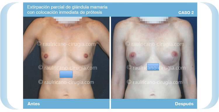 Reconstruccion - Senos, mamas  - caso 2, mamas ,  mejor cirujano plástico Puebla