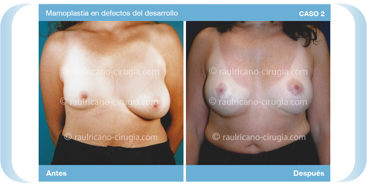 Reconstruccion - Senos, mamas - caso 2, mamas, mejor cirujano plástico Puebla
