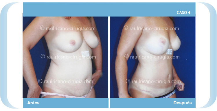 E-abdominoplastía-con-lipo-más-levantamiento-mamario-2-tres-cuartos-dch-Caso-4