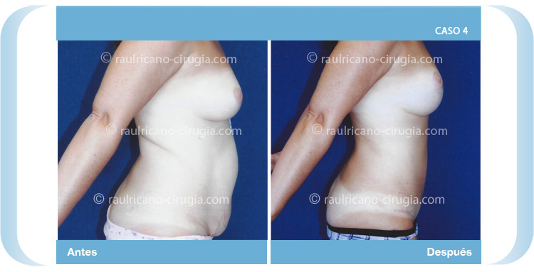 E-abdominoplastía-con-lipo-más-levantamiento-mamario-4-perfil-dch-Caso-4