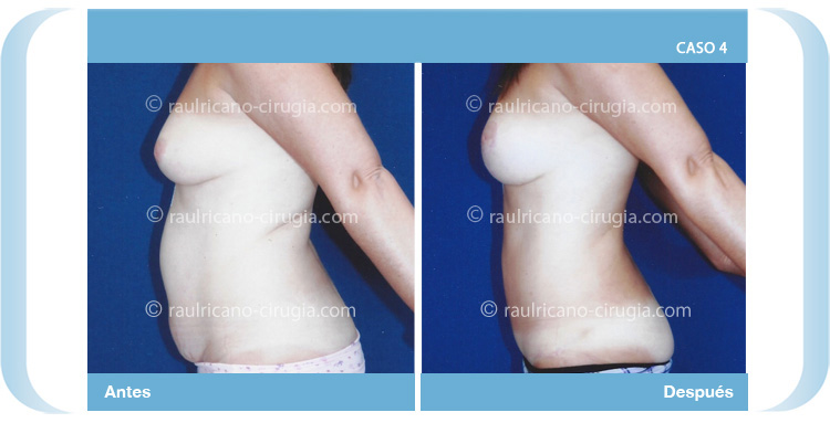 E-abdominoplastía-con-lipo-más-levantamiento-mamario-5-perfil-izq-Caso-4