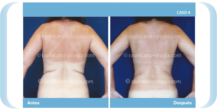 E-liposucción-espalda-frente1