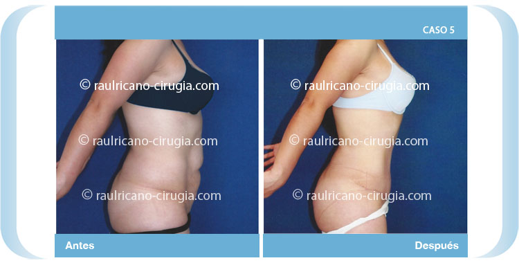 Espalda y abdomen D